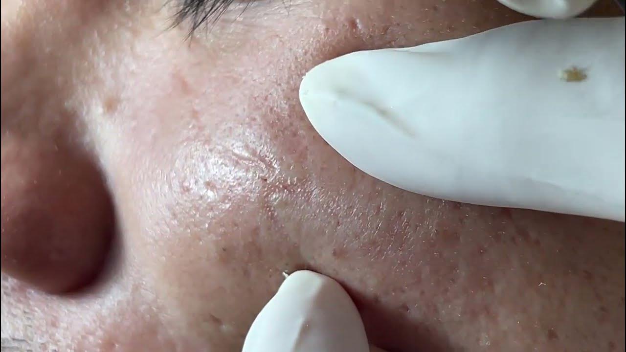 ACNE TREATMENT MAI NGOC DA NANG - YouTube