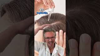 WHY MINOXIDIL IS THE BEST HAIR LOSS TREATMENT IN 2024