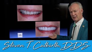 Veneering Dark Teeth - Dental Minute with Steven T. Cutbirth, DDS