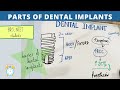 basics of dental implants - parts of implant