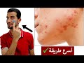 وصفة مذهلة للتخلص من حبوب الشباب وحبوب الوجه نهائيا
