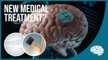 Brain Implants are Here: Blackrock