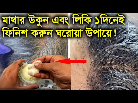 ভিডিও: উকুনের পর পরিষ্কার করার টি উপায়