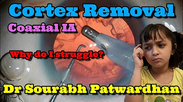 Cortex Aspiration with coaxial IA : why do I struggle - Dr Sourabh Patwardhan Thinking process