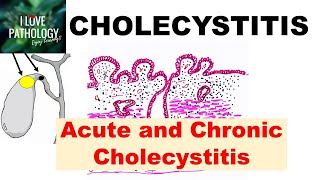 CHOLECYSTITIS: Acute and Chronic. Pathology and Complications