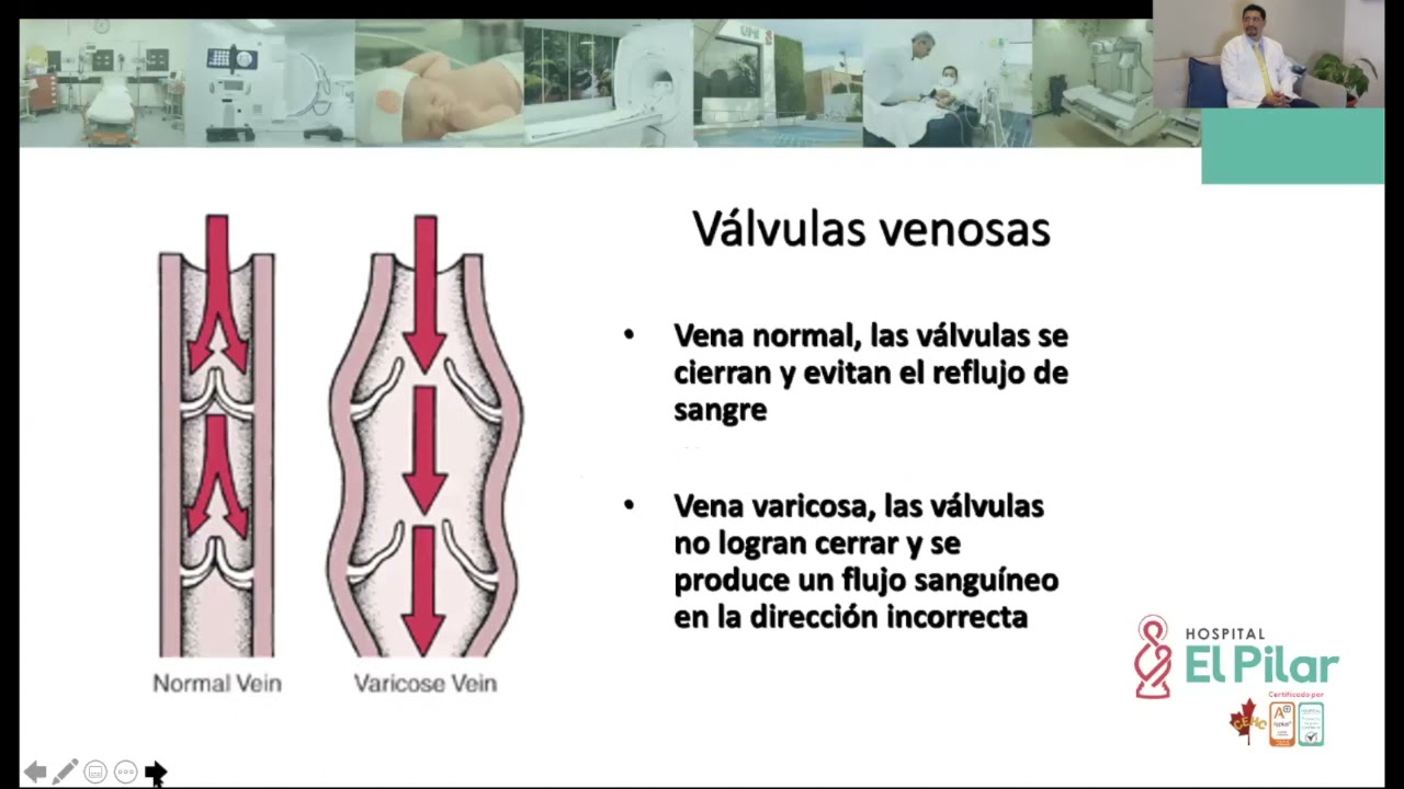 tratamentul revizuirilor varicoase cât costa o operaie varicoasa