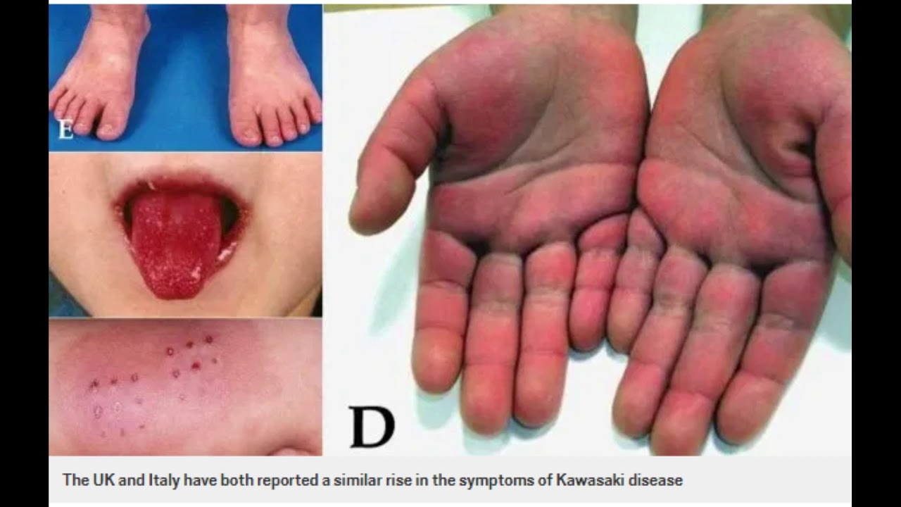 Coronavirus may be linked to Kawasaki disease, a rare condition in ...