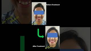 Braces Treatment : Before &amp; After