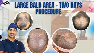 Hair Transplant In Chennai | Best Clinic Doctor Results & Surgeon Of Hair Transplant Of Chennai