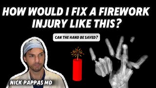 How to manage a severe firework injury by Nick Pappas MD, board-certified hand surgeon