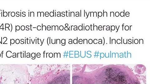 The #EBUSTwitter study