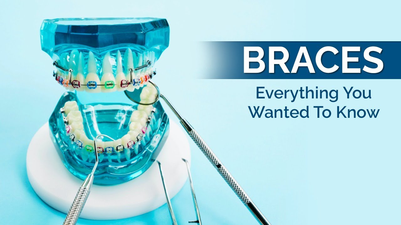 Braces - Everything You Wanted To Know - YouTube