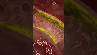 How a Tiny Stent Can Save Your Life. #afterangioplasty,#angioplastyexplained, #hearttreatment