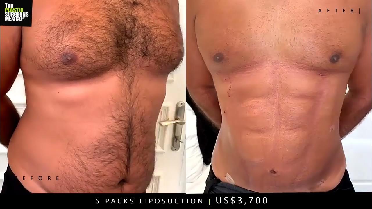 US3,700 Ab Etching 6 Packs Surgery ️www.TopPlasticSurgeonsMexico
