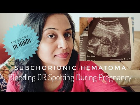 Subchorionic Hematoma My Story In Hindi Bleeding Or Spotting During Pregnancy In Hindi Symptom Youtube
