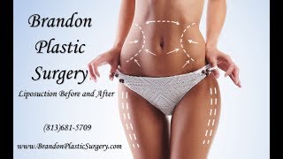 Liposuction For Belly Protuberance And Stomach Rolls