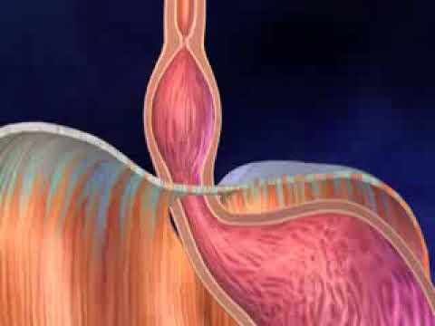 Vidéo: Comment guérir les dommages causés par le reflux acide (avec photos)