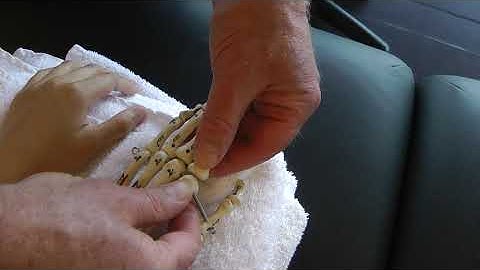 Page 90, 97 Metacarpophalangeal,  Jt Distraction of the MCP, PIP, Jts