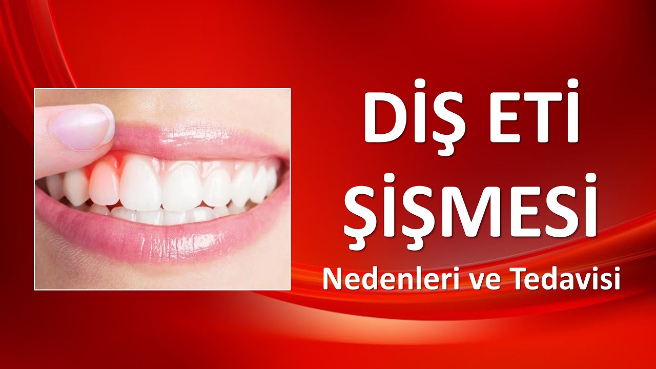 DİŞ ETİ ŞİŞMESİ Nedenleri ve Tedavisi