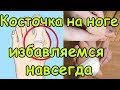 Косточка на ноге большого пальца  народная медицина Как избавиться от косточки на ноге