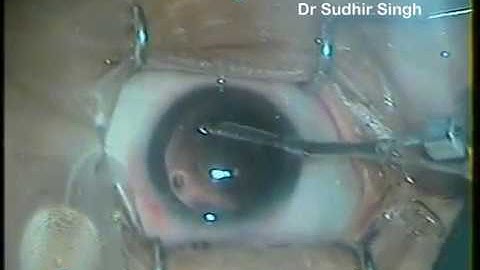 Cortical Matter Clean Up By Simcoe Irrigation Aspirating Cannula