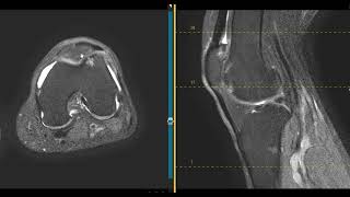 Knee pain in 63 year old grandmother - YouTube