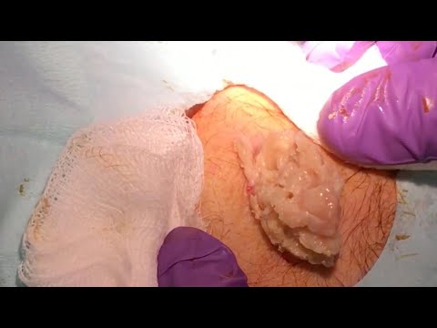 Massive Cyst