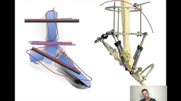 Foot Frame  Strategy and Osteotomies