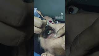 Syringing test for lacrimal apparatus patency
