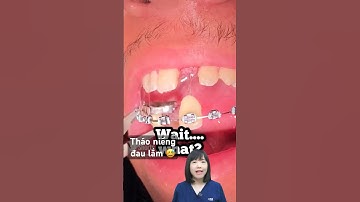 Tháo niềng răng làm rụng răng | Dr Anh Thư