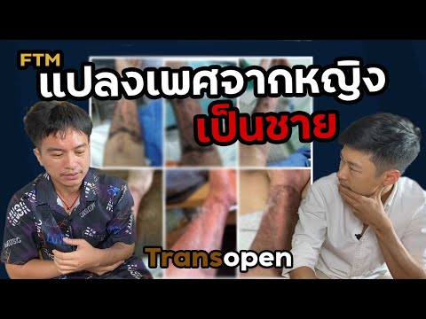 Transopen Ep.10 l แชร์ประสบการณ์แปลงเพศจากหญิงเป็นชาย จากเนื้อท่อนแขน เทคนิคแบบฟาลโล (Phalloplasty)