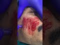 vampire facial#shorts Contact Cochin-8891426652   Payyanur-8078800335