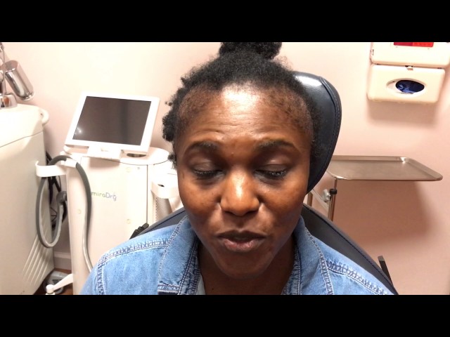 African-American Traction Alopecia Hair Transplant Immediately After