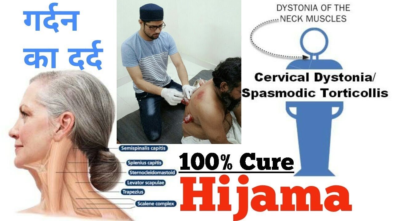 Hijama For Cervical Dystonia Spasmodic Torticollis गर्दन का दर्द
