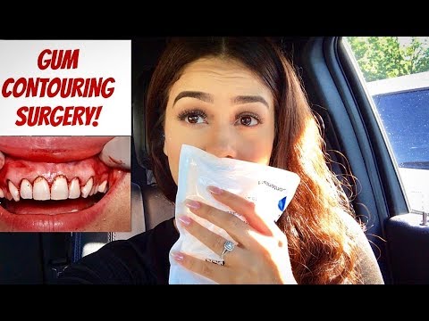 Gum Contouring Surgery/Procedure Vlog | My Experience