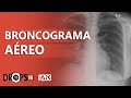 Broncograma areo  existe mesmo