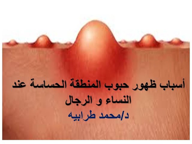 أسباب حبوب الإشارة إلى المنطقة التناسلية للرجل - العلاجات المنزلية الطبيعية