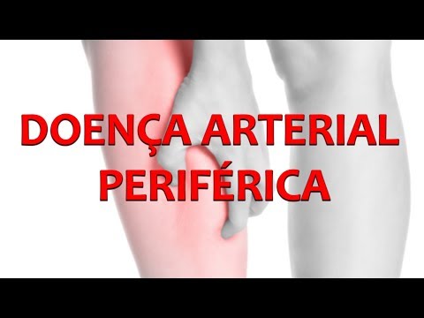 Vídeo: Aterosclerose Obliterante Das Artérias Das Extremidades Inferiores - Causas, Sintomas E Tratamento