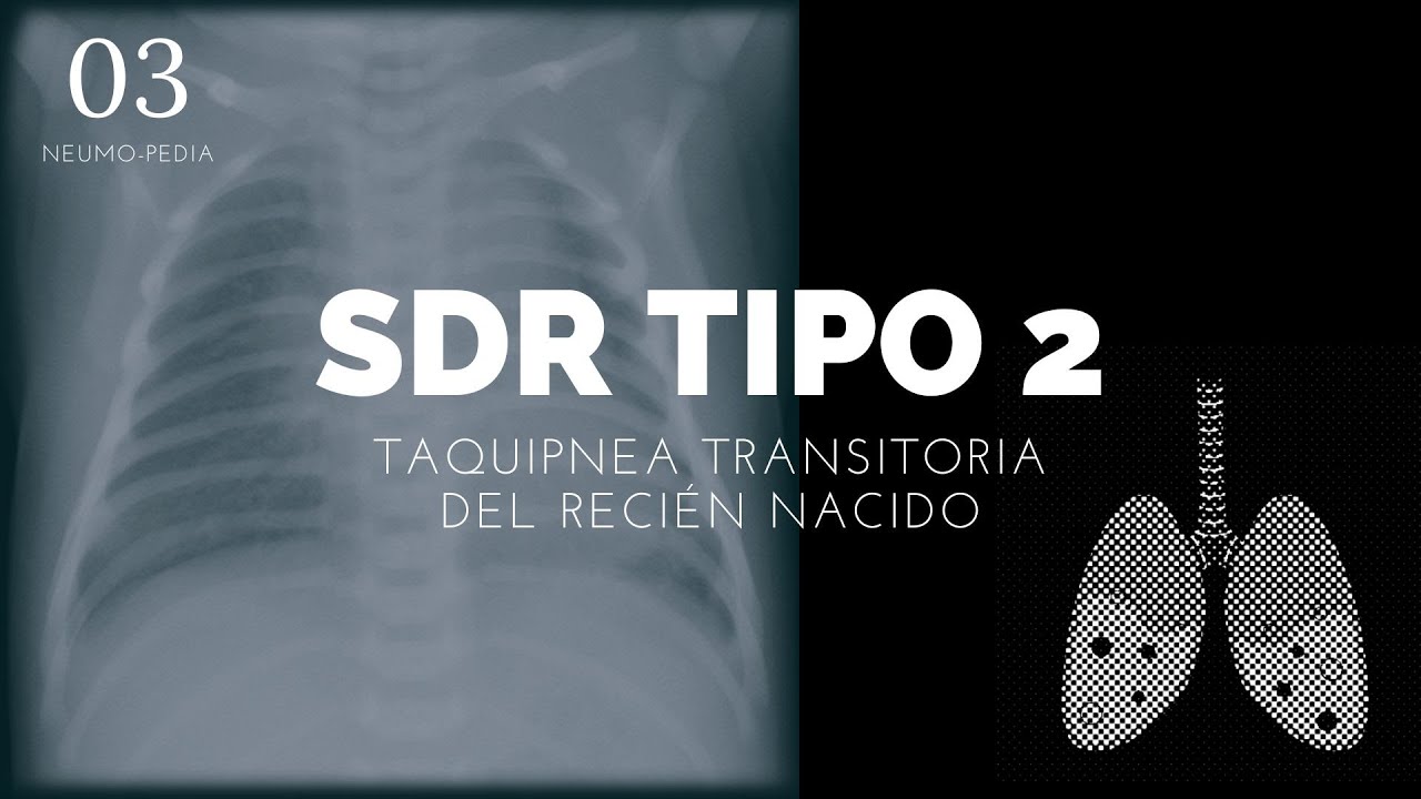 Taquipnea transitoria del recién nacido - ENARM