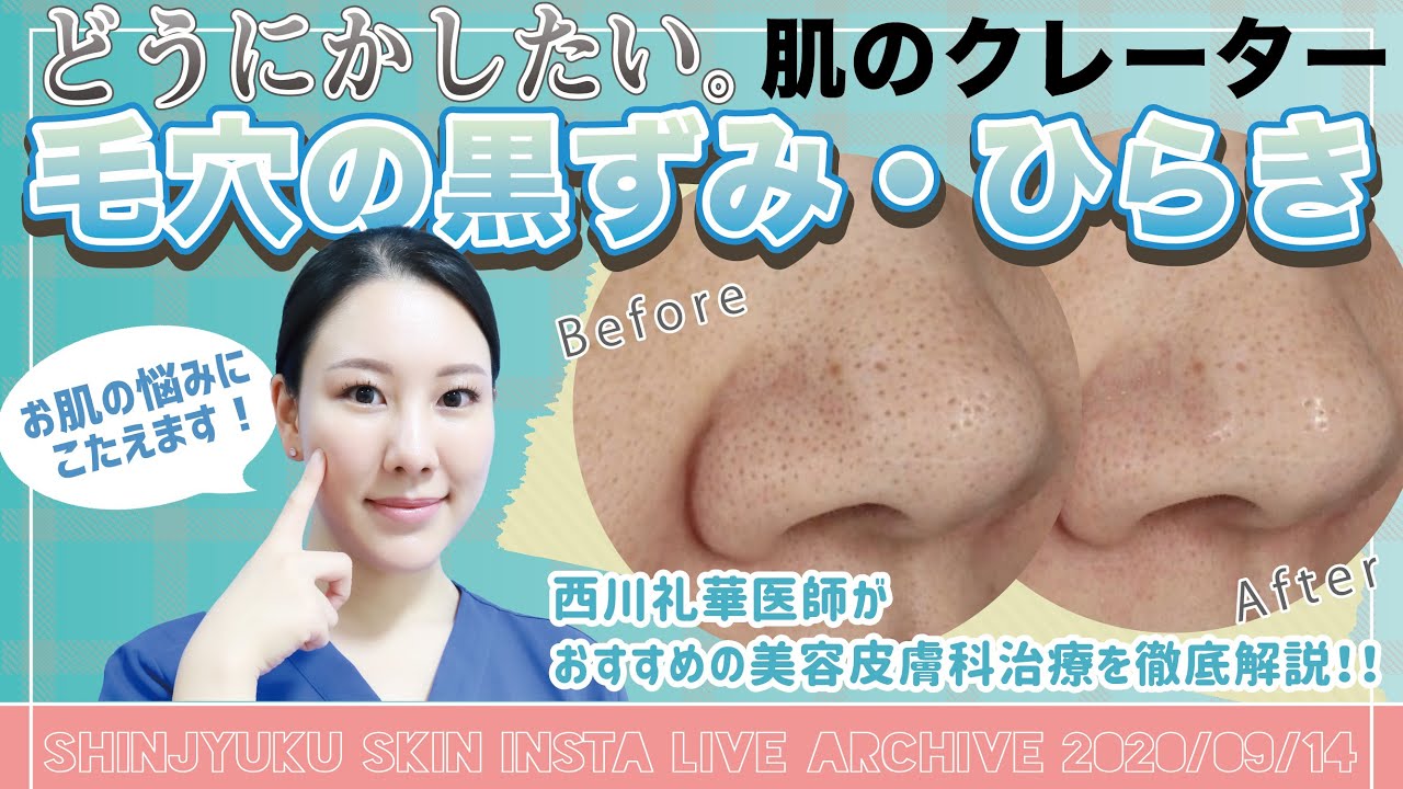 【肌のクレーター！毛穴の黒ずみ・汚れ・開き！】美容皮膚科の治療法を徹底解説【インスタライブアーカイブ_スキンケアvol.2】 - YouTube