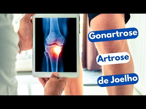 Vídeo: Gonartrose Bilateral 1, 2, 3 Graus: Tratamento, Sinais, Causas