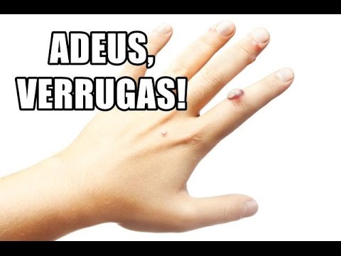Vídeo: Verruga No Dedo: Como Se Livrar Dela Em Casa, Foto
