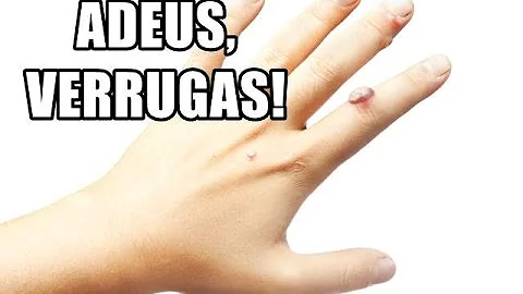 Como tirar verrugas com leite de mamao?