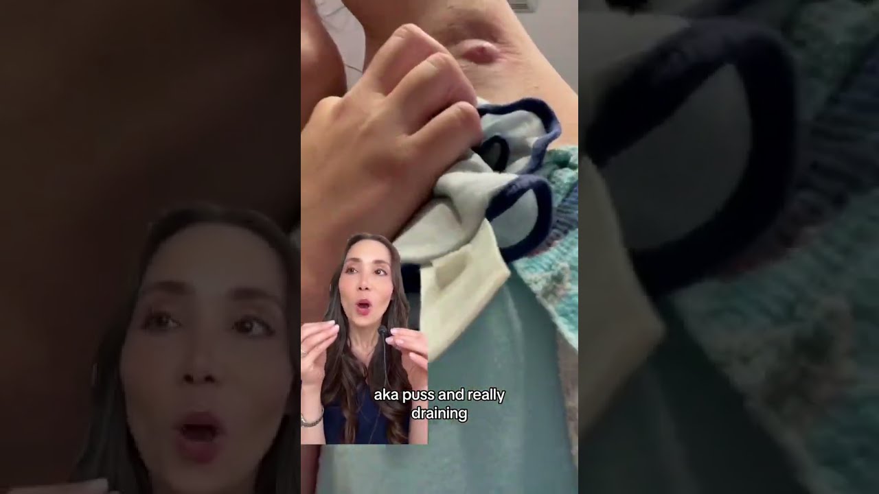 Armpit Cyst