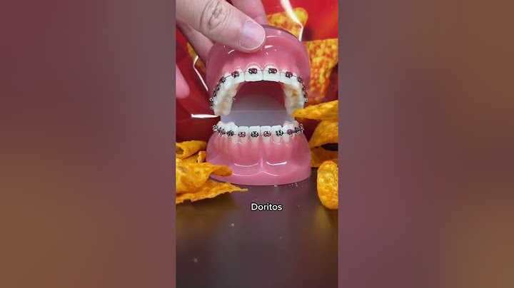 Chips to avoid with braces #braces #chips