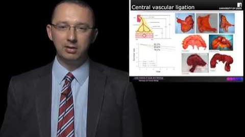 State of the Art Masterclass Lecture: Complete Mesocolic Excision for Colon Cancer