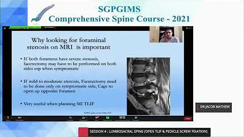 Radiological evaluation prior to TLIF, Dr  Jacob E...