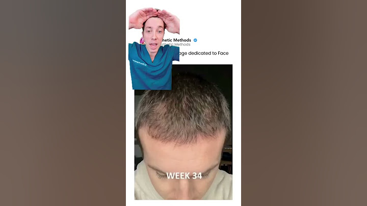 Hair Transplant Recovery Timeline