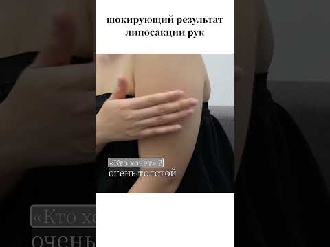 Липосакция рук До и после Клиника Пластической Хирургии Гирин