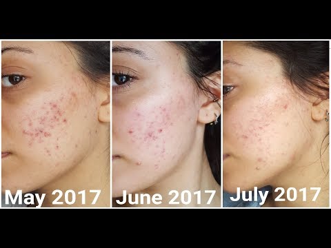 2 months on Accutane or Isotretinoin UK